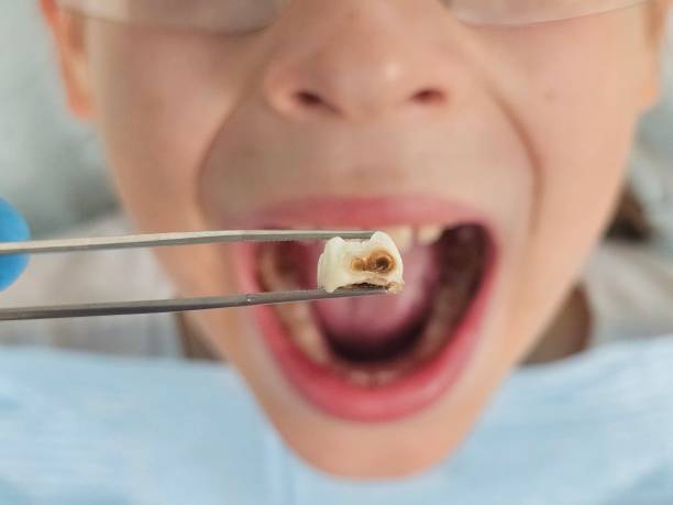 Best Emergency Dental Care for Broken or Chipped Teeth in Crockett, TX